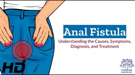 anal tunnel|Anal Fistula: What It Is, Symptoms, Treatment & Surgery.